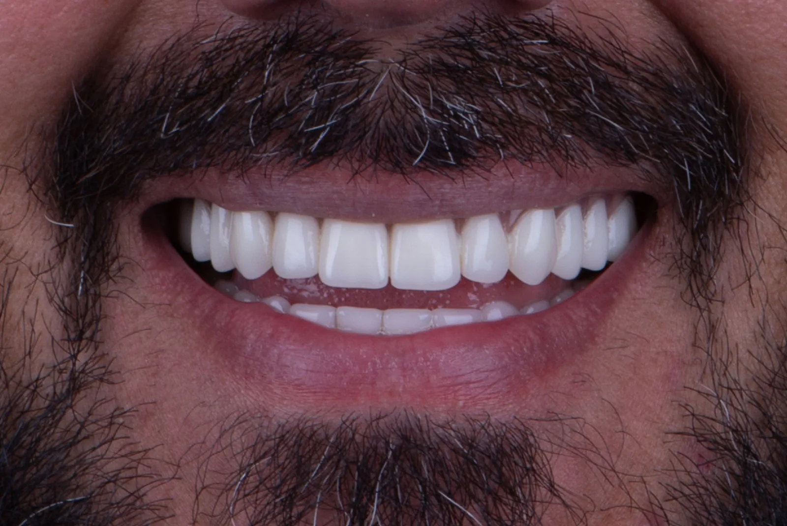 After — Before & after smile transformation