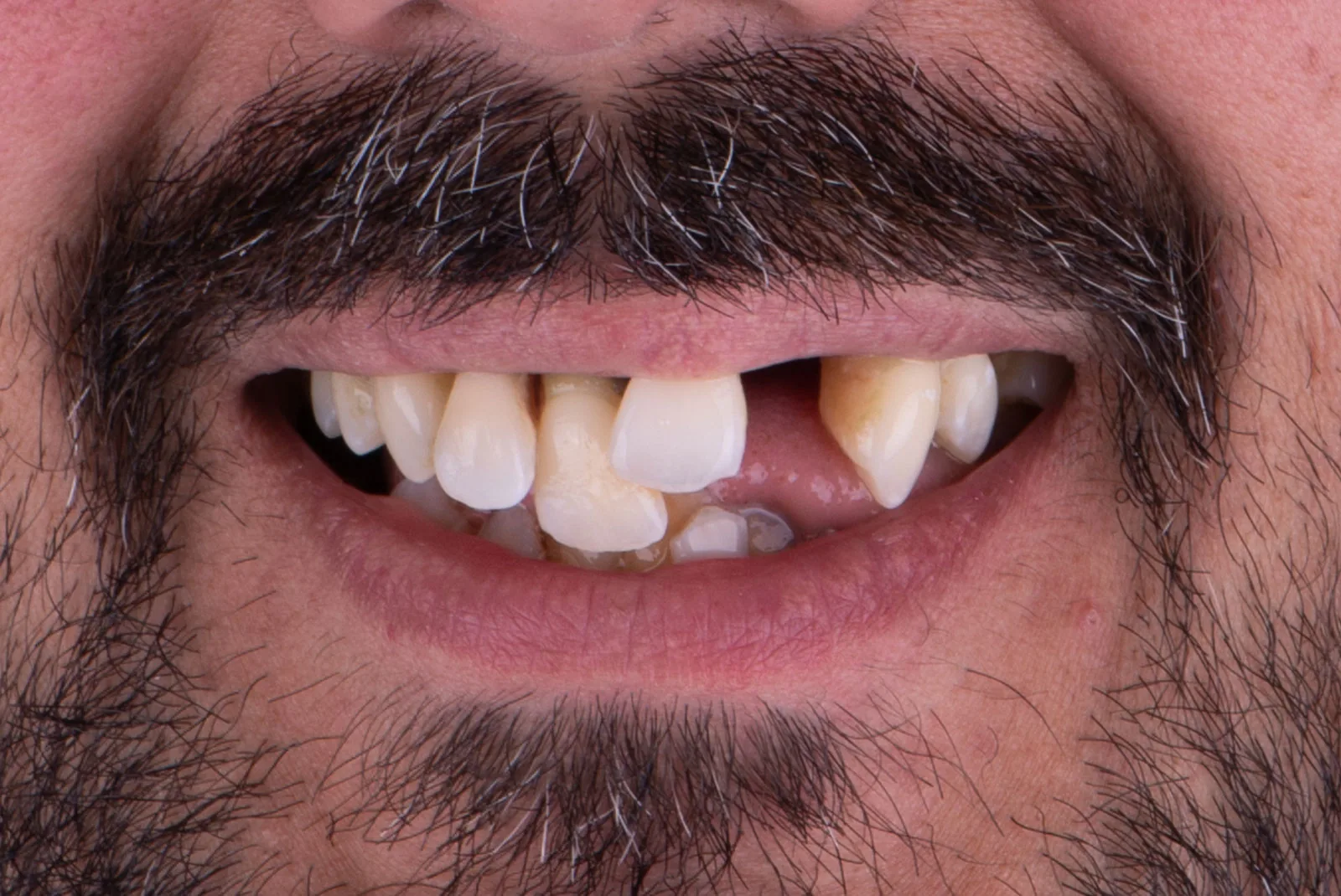 Before — Before & after smile transformation