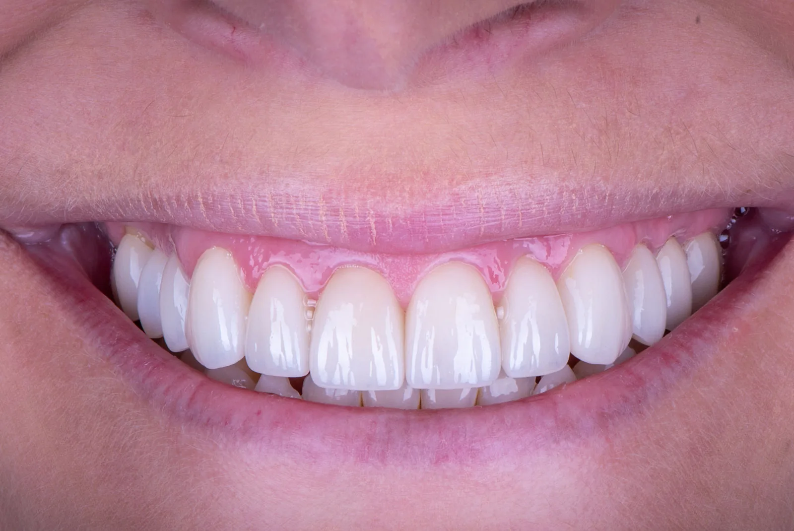 After — Before & after smile transformation