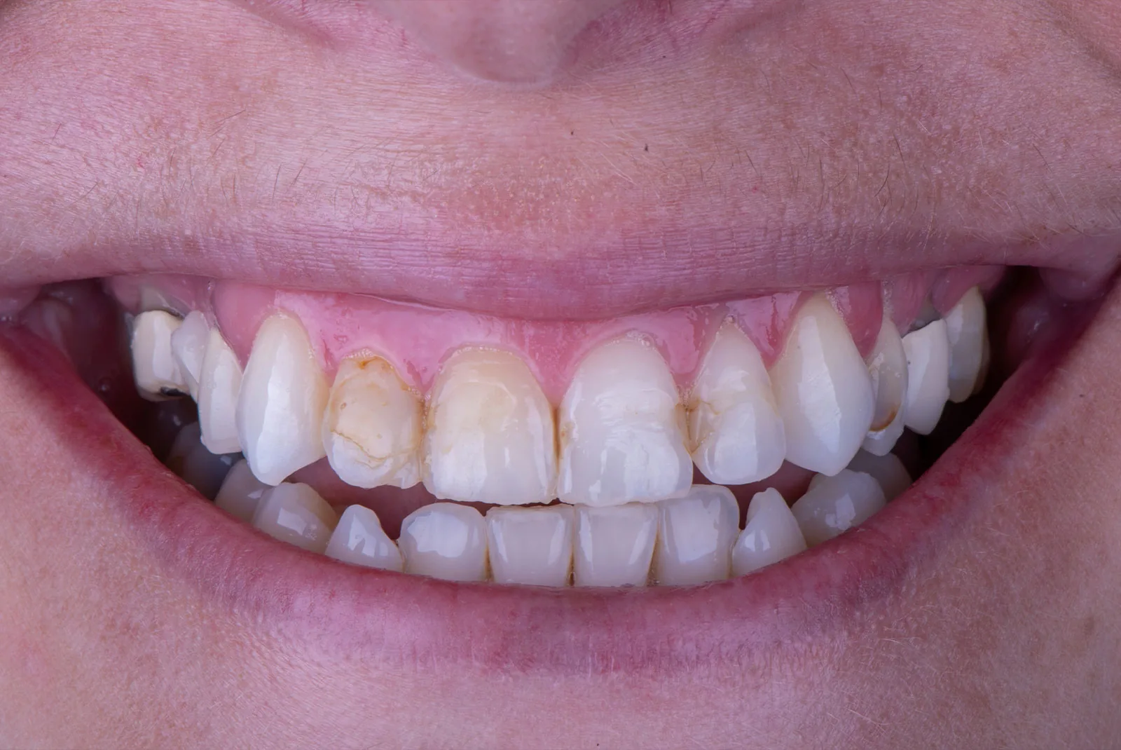 Before — Before & after smile transformation