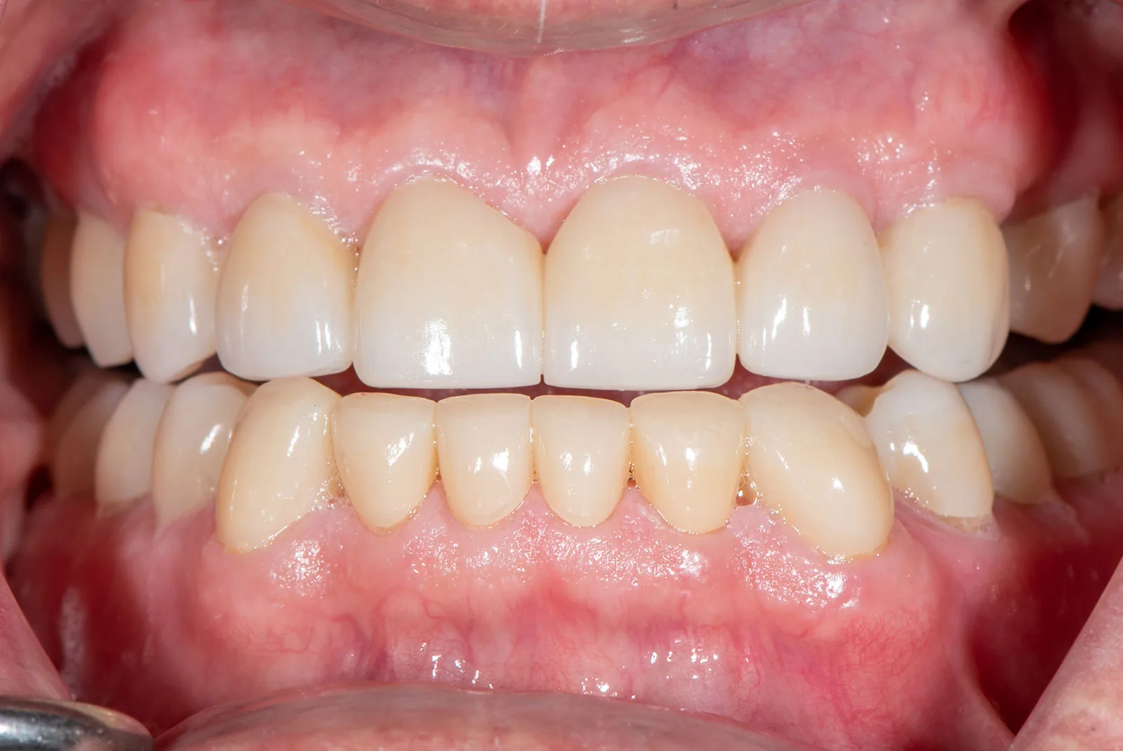 After — Before & after smile transformation