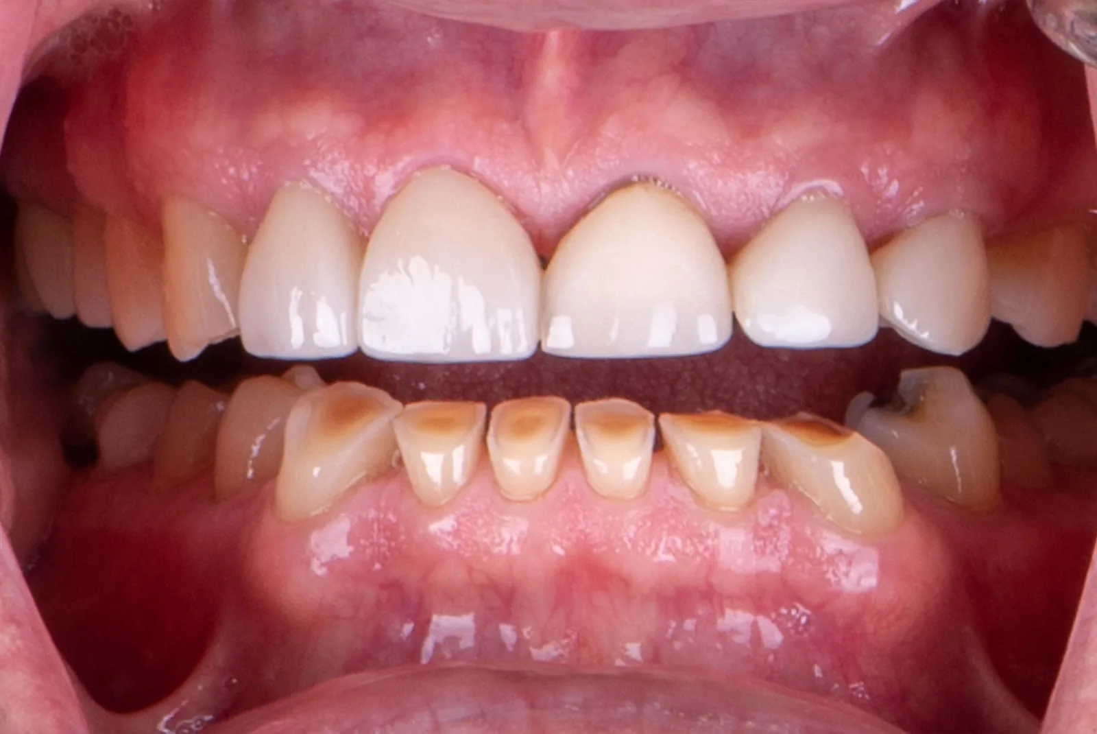Before — Before & after smile transformation