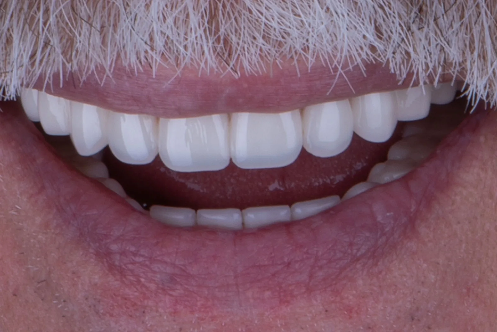 After — Before & after smile transformation
