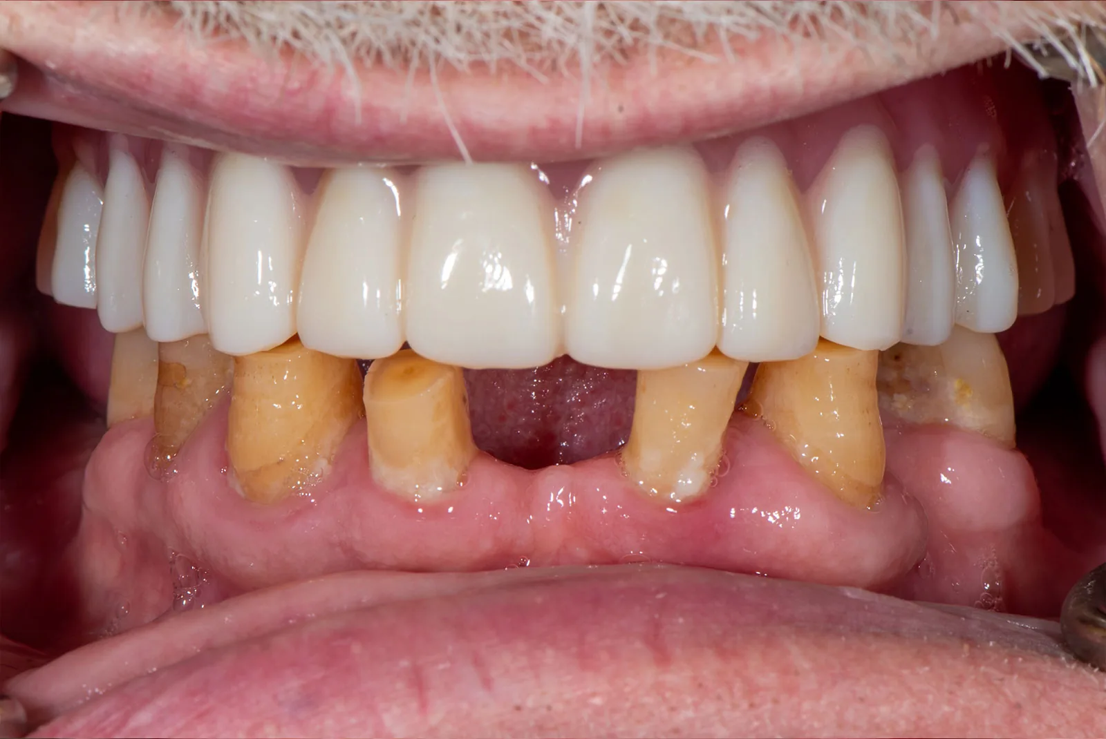 Before — Before & after smile transformation