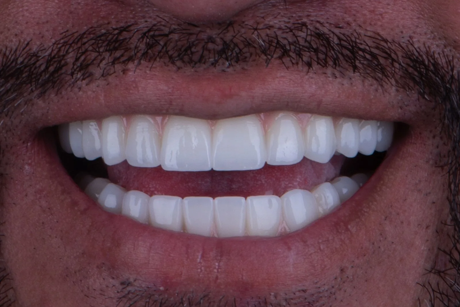 After — Before & after smile transformation
