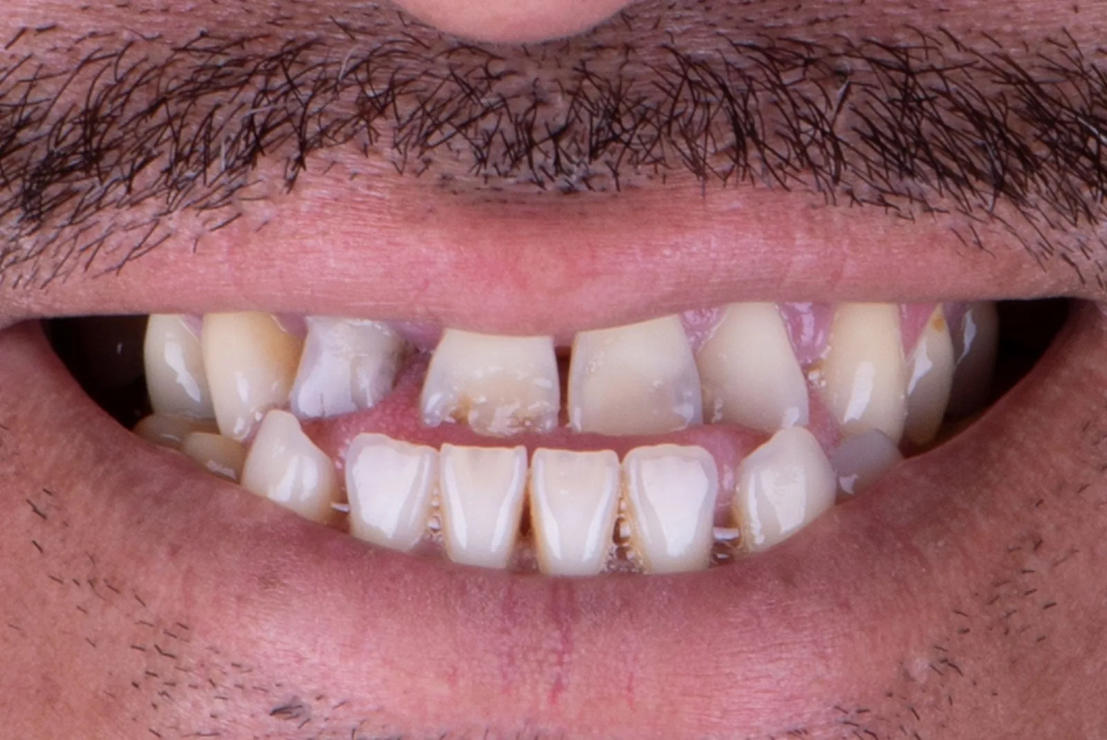 Before — Before & after smile transformation