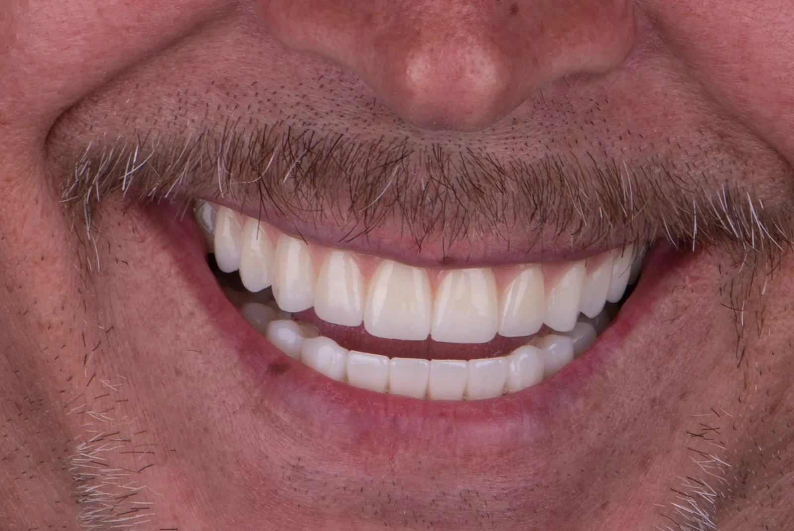 After — Before & after smile transformation