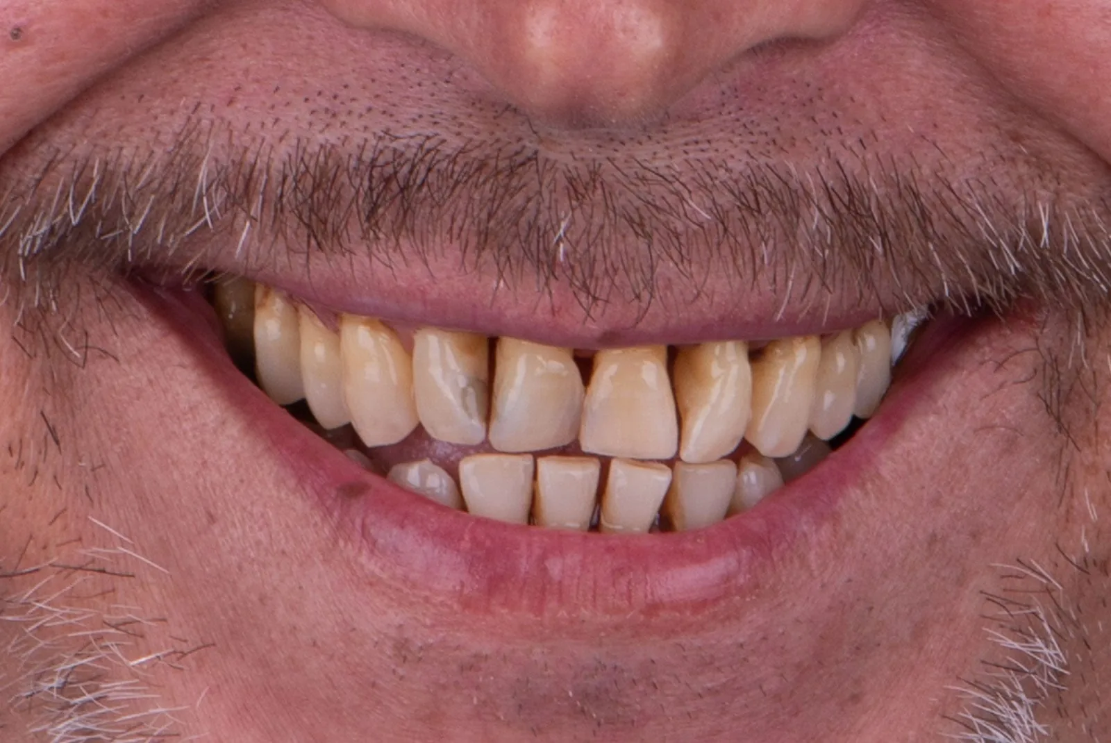 Before — Before & after smile transformation