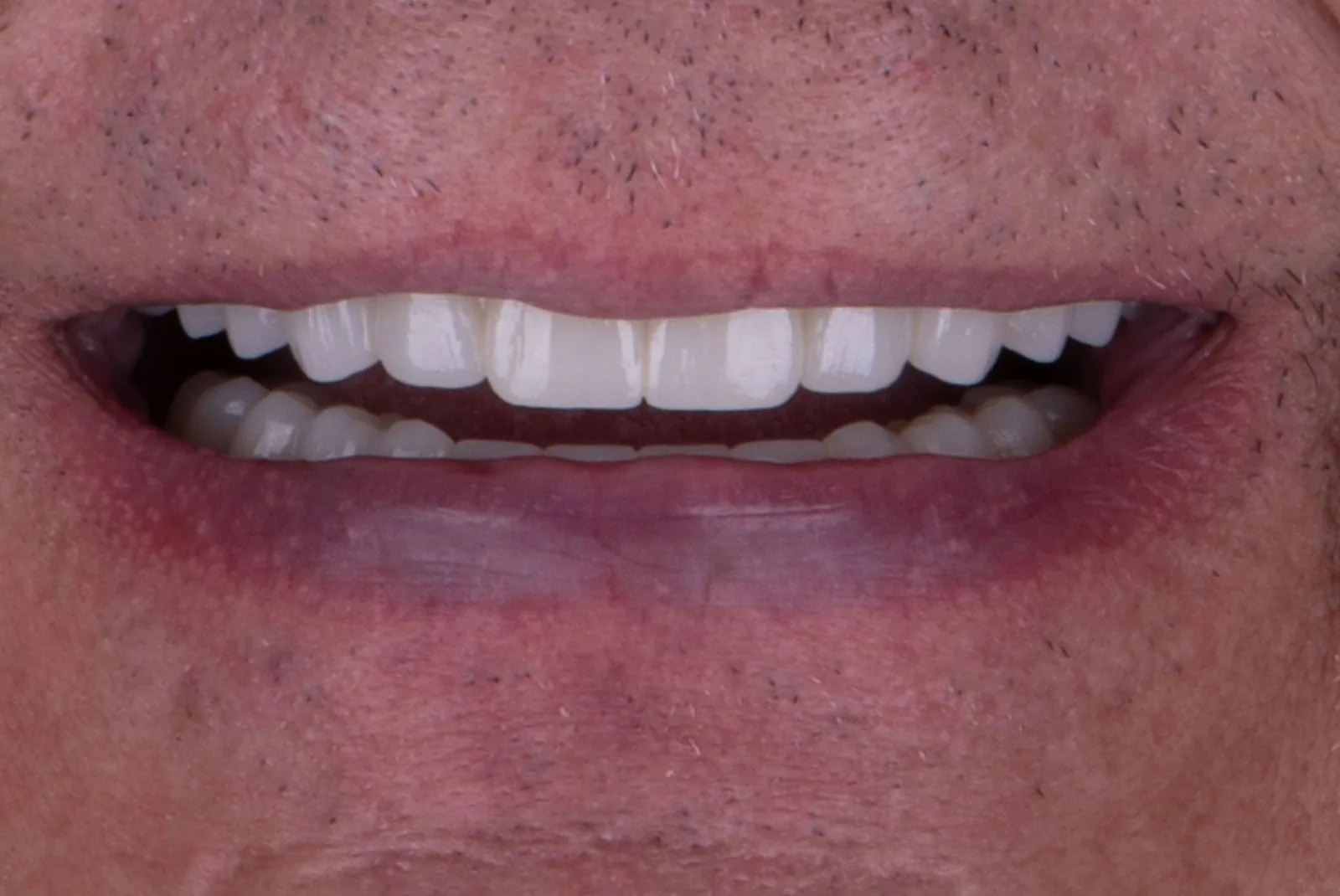 After — Before & after smile transformation