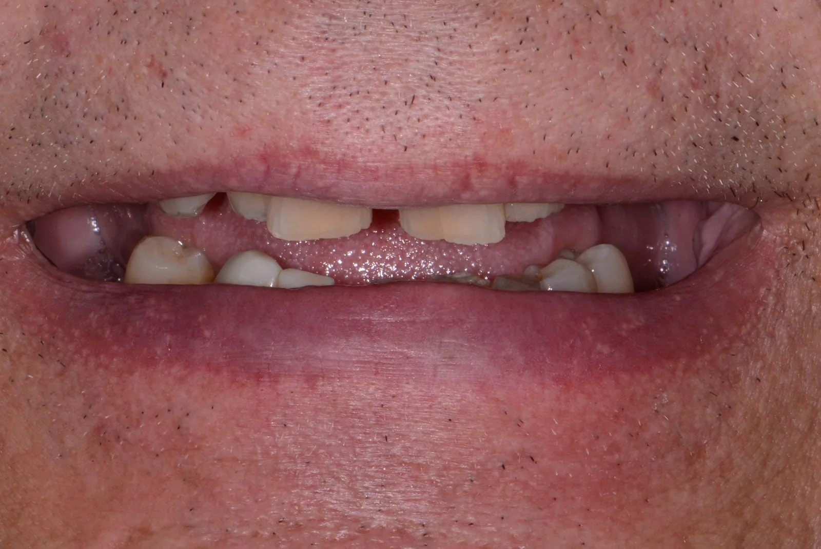 Before — Before & after smile transformation