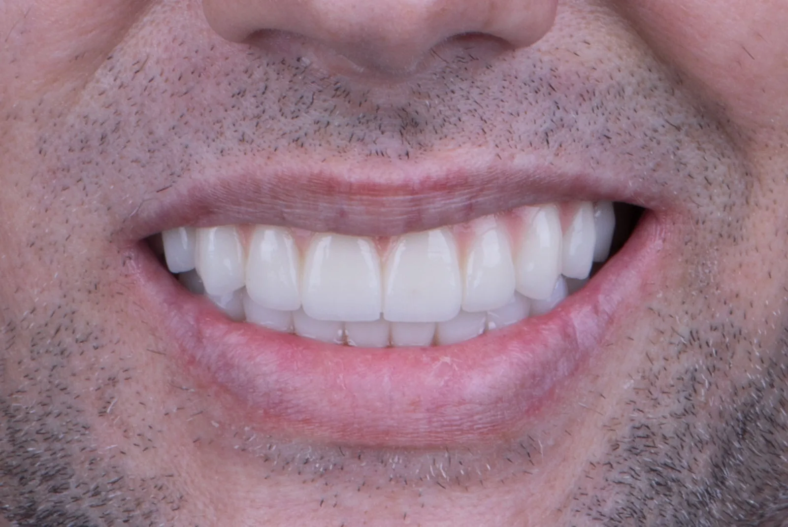 After — Before & after smile transformation