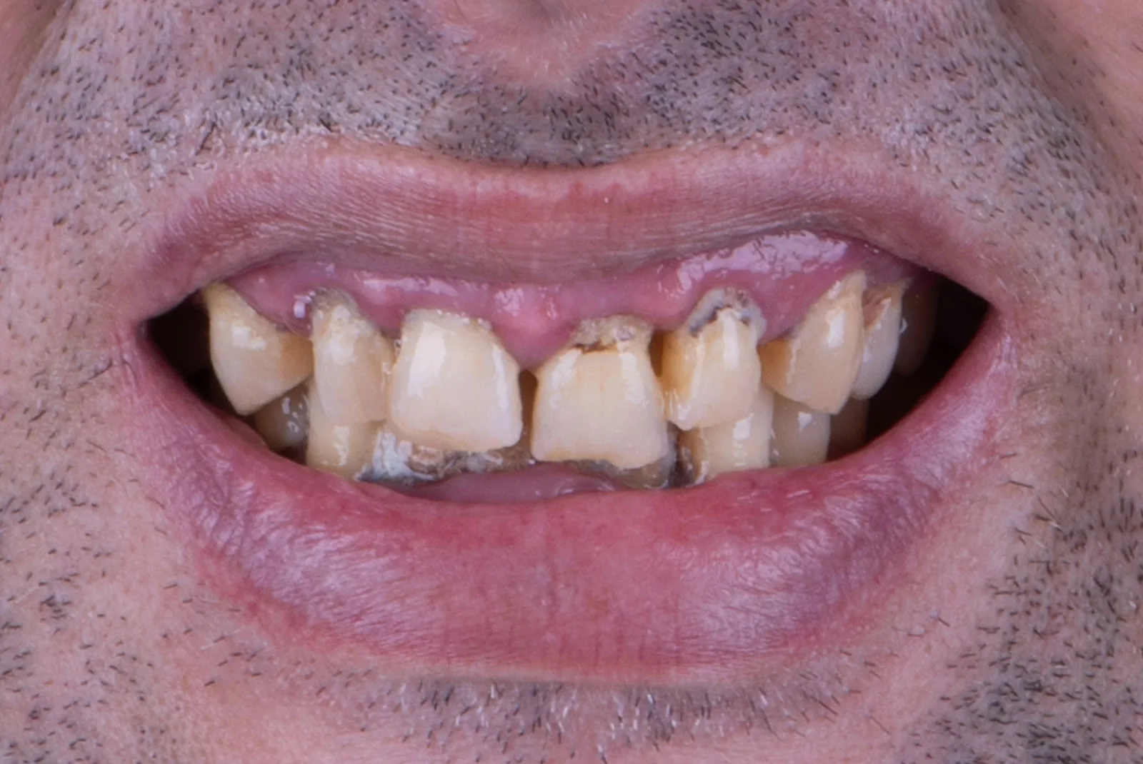 Before — Before & after smile transformation