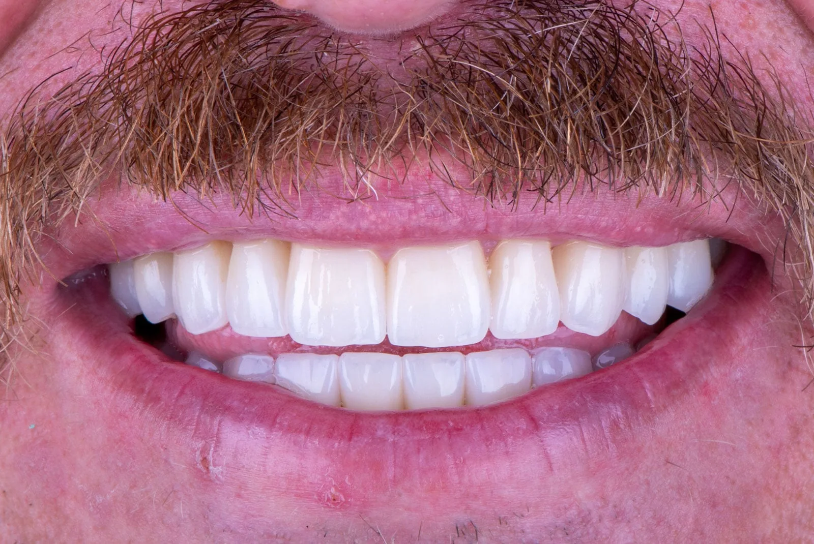 After — Before & after smile transformation