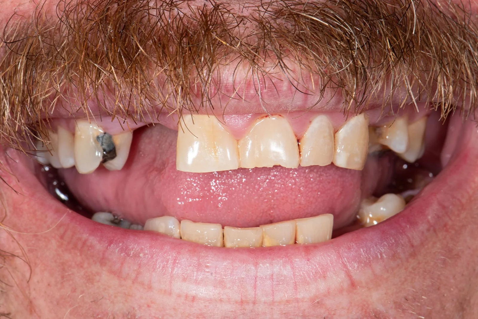 Before — Before & after smile transformation