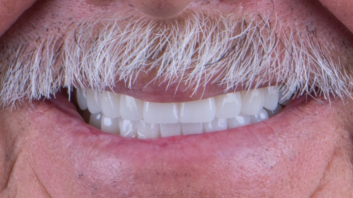 After — Jorge's smile transformation
