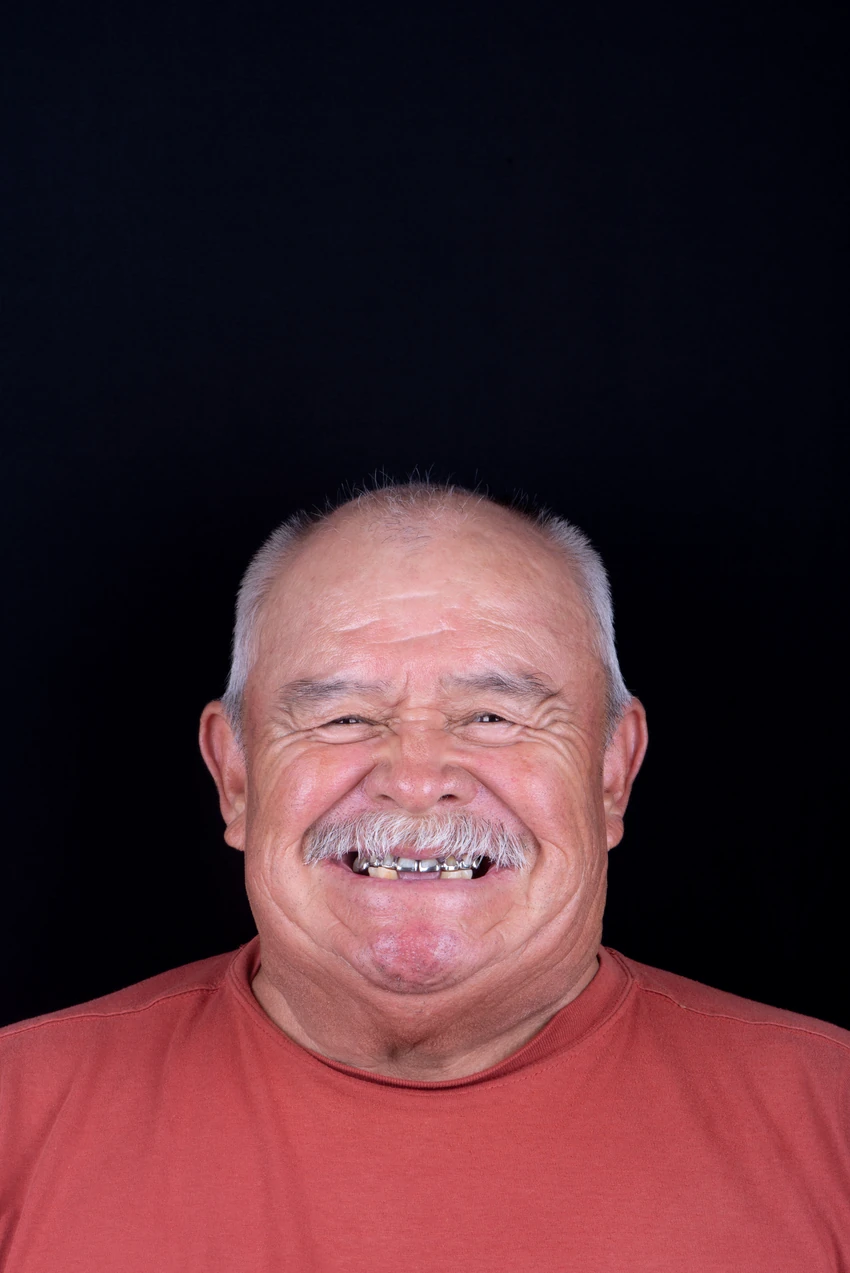 Before — Jorge's smile transformation, portrait