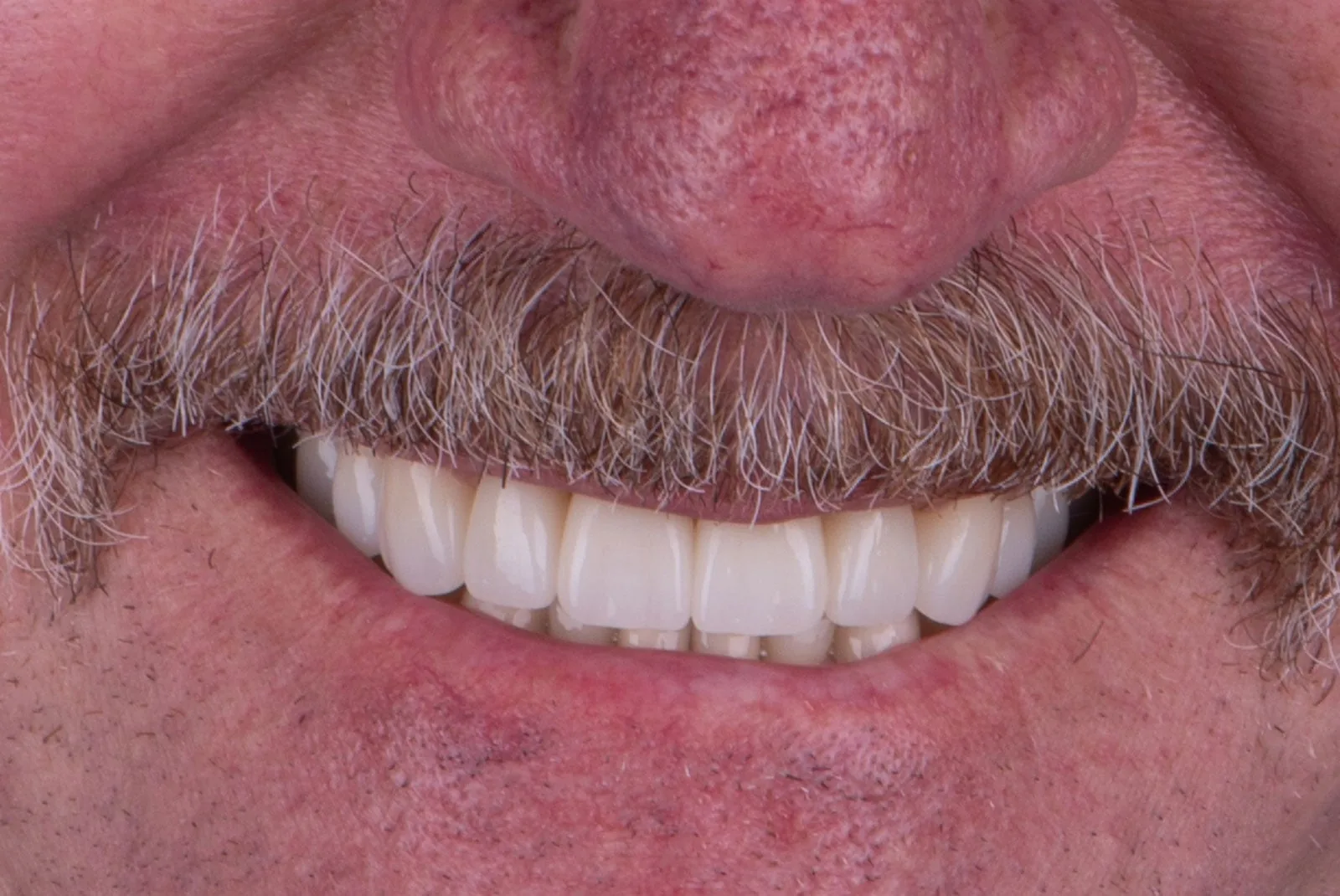 After — Before & after smile transformation