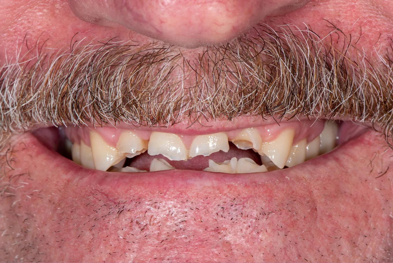 Before — Before & after smile transformation