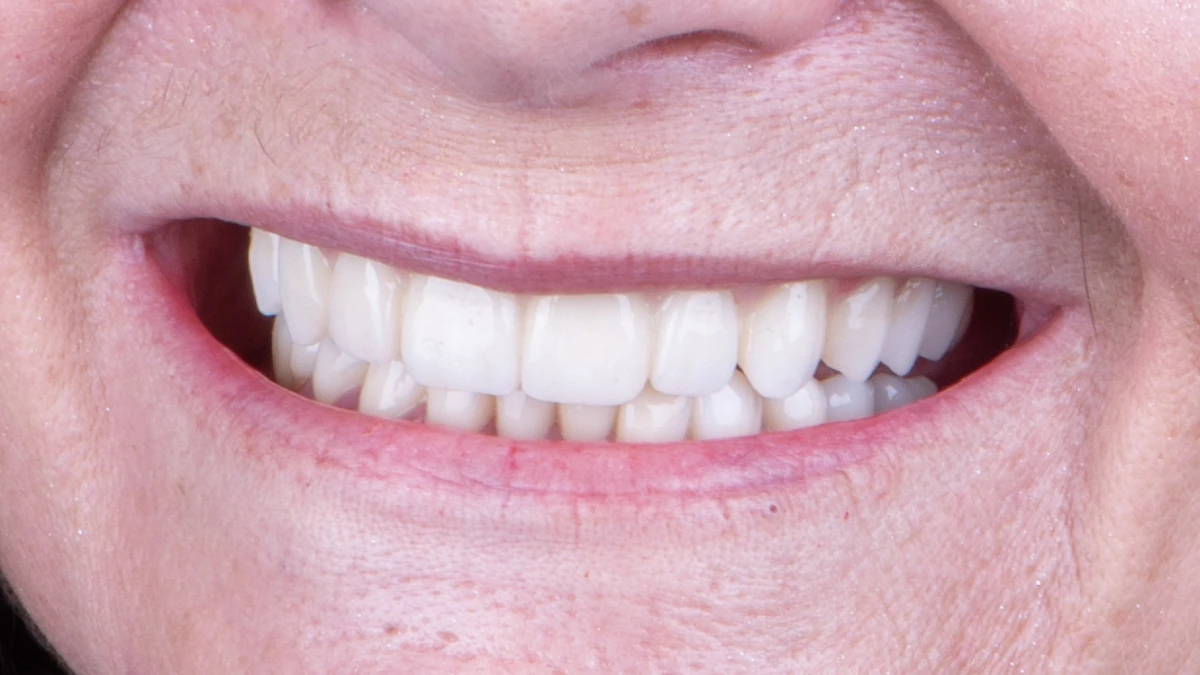 After — Margie's smile transformation