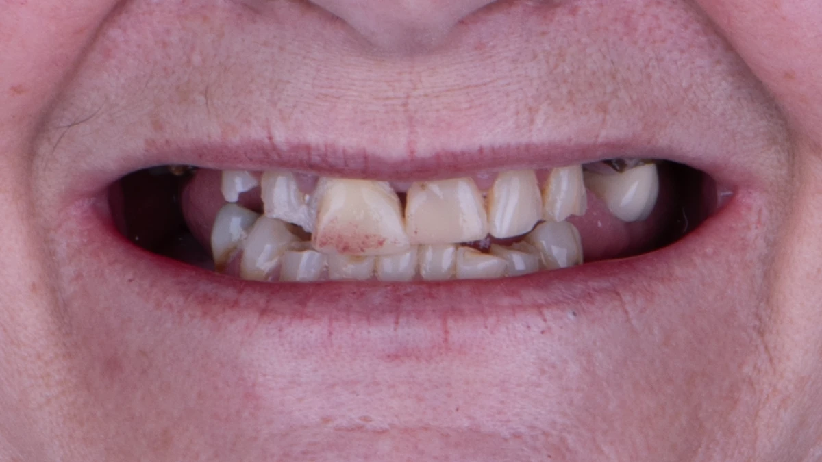 Before — Margie's smile transformation