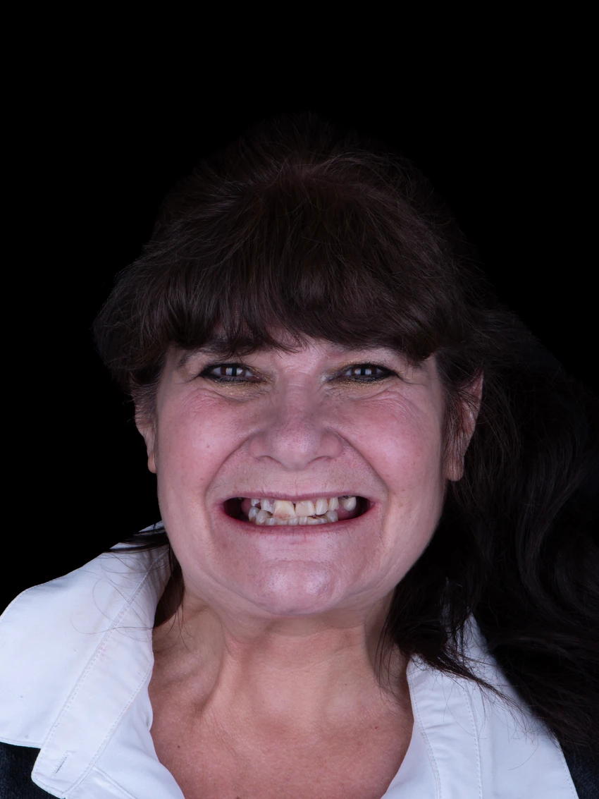 Before — Margie's smile transformation, portrait