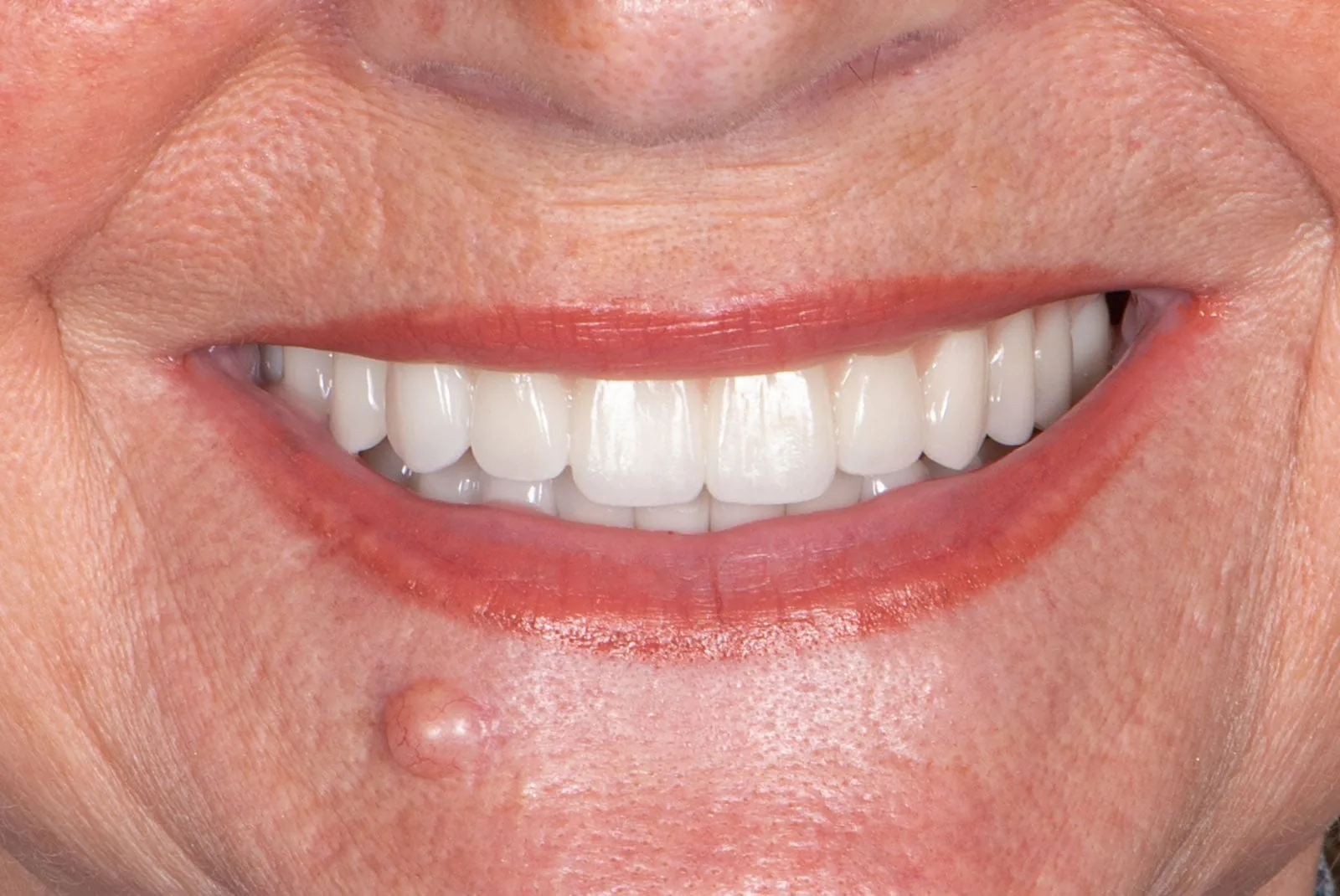 After — Before & after smile transformation