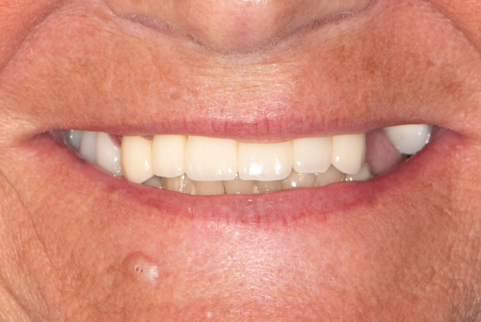 Before — Before & after smile transformation