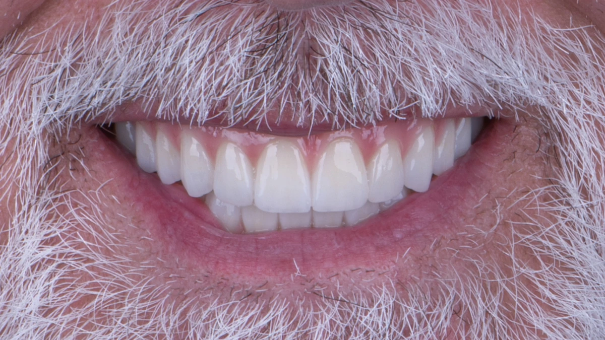 After — Steve's smile transformation