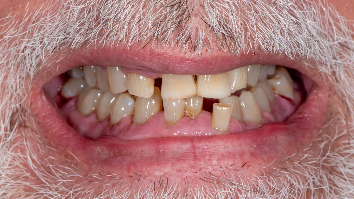 Before — Steve's smile transformation
