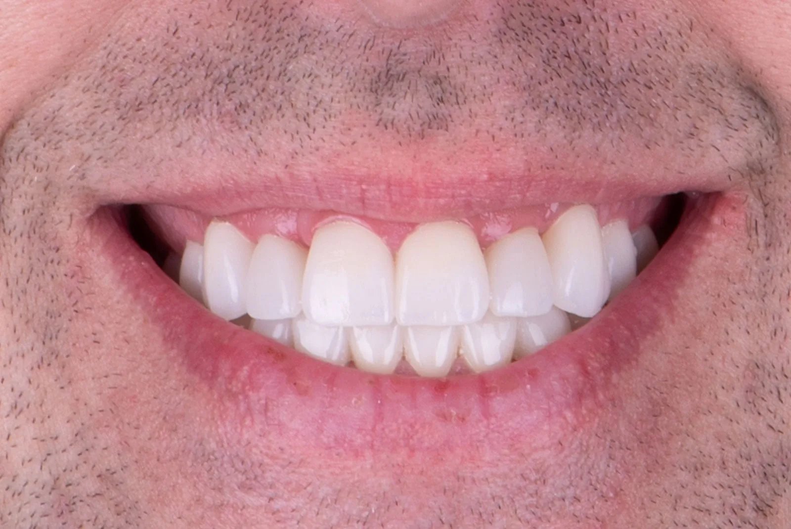 After — Before & after smile transformation