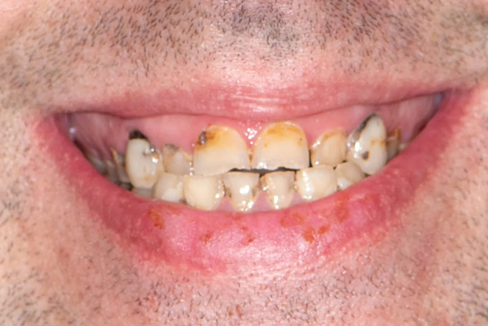 Before — Before & after smile transformation