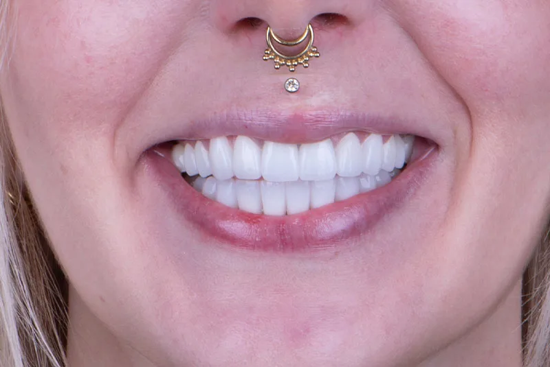 After — Before & after smile transformation