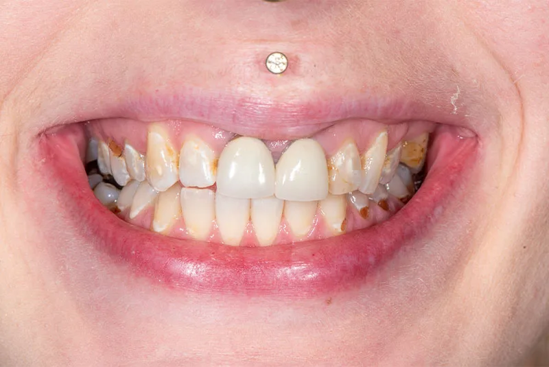 Before — Before & after smile transformation