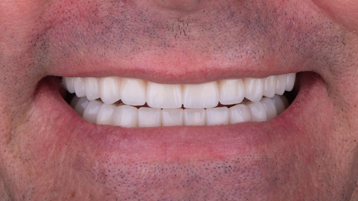 After — Complete smile transformation