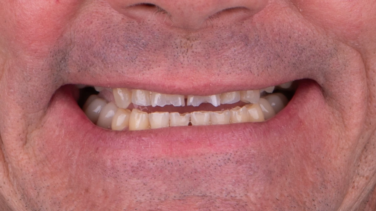 Before — Complete smile transformation