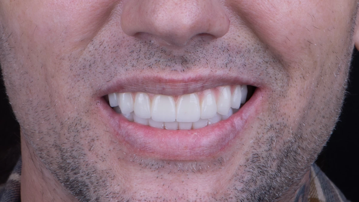 After — Complete smile transformation