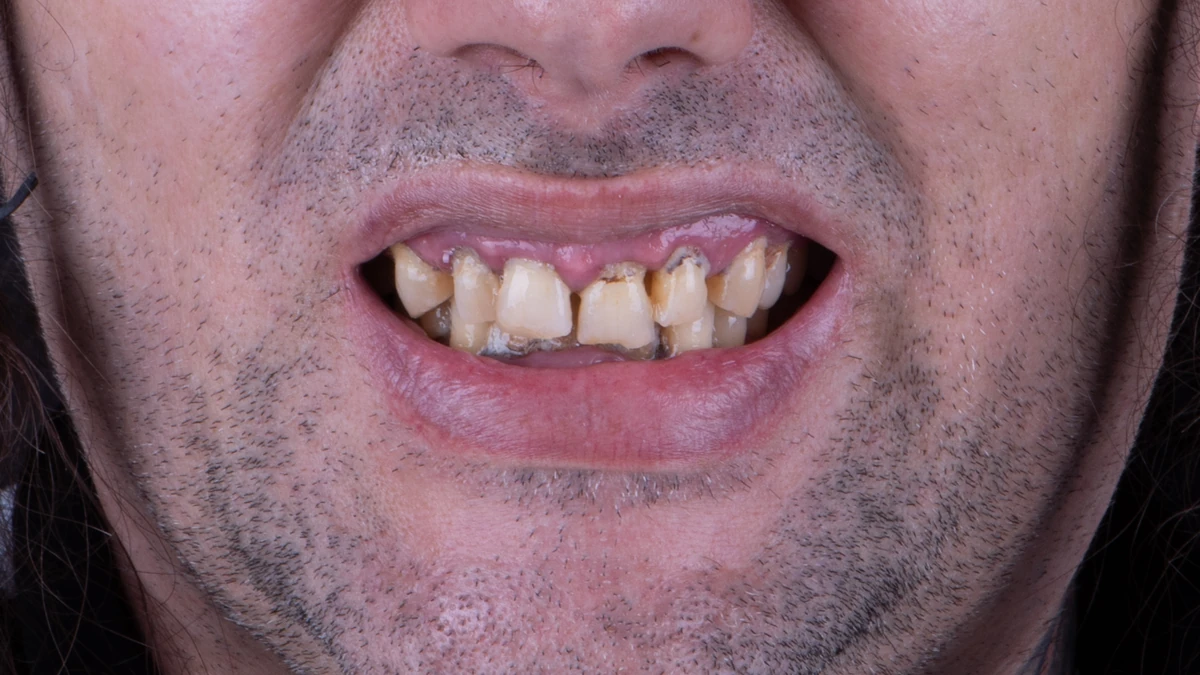 Before — Complete smile transformation