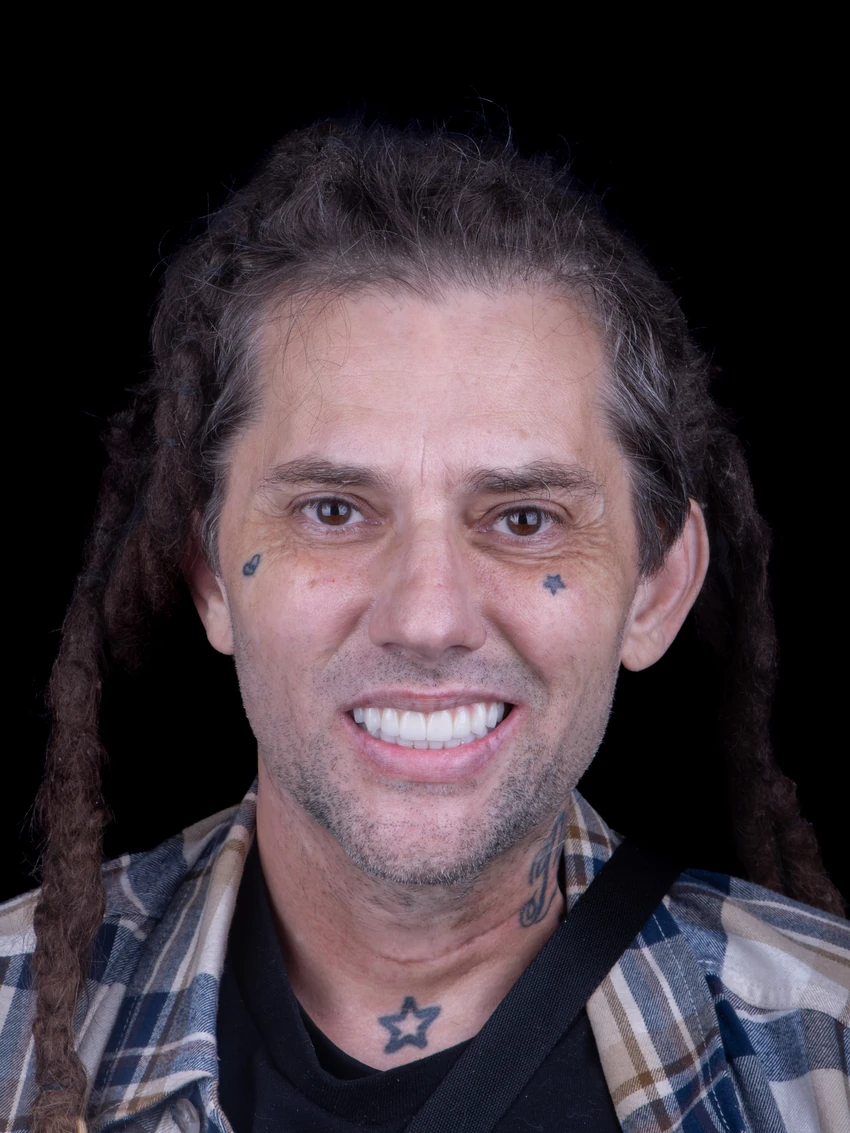 After — Complete smile transformation, portrait