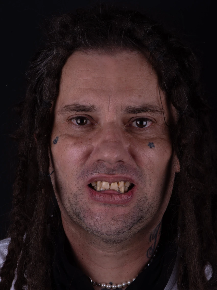 Before — Complete smile transformation, portrait