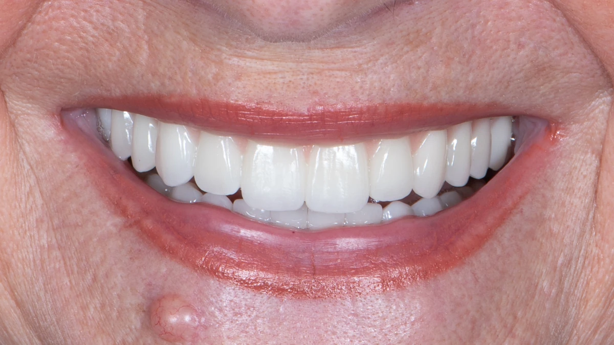 After — Complete smile transformation
