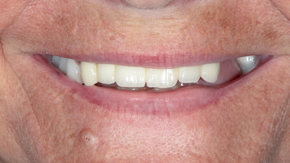 Before — Complete smile transformation