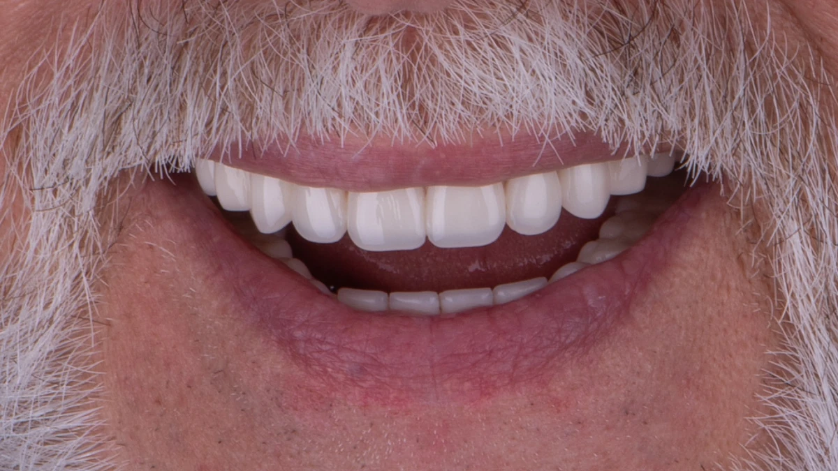 After — Complete smile transformation
