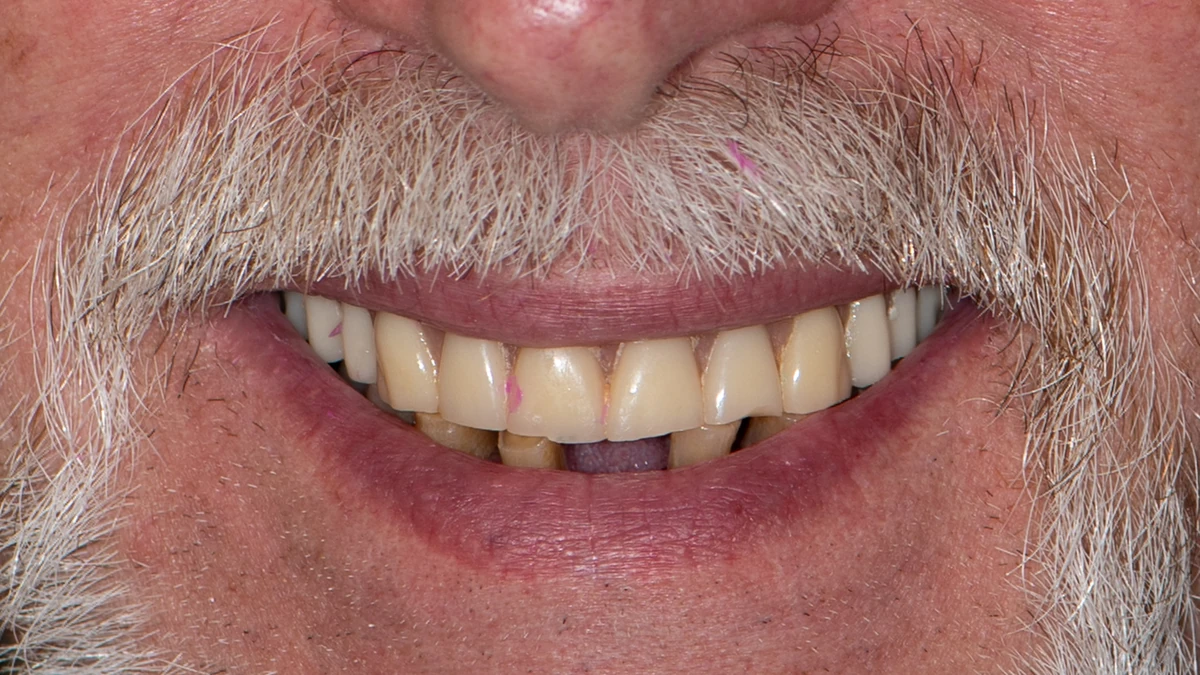 Before — Complete smile transformation