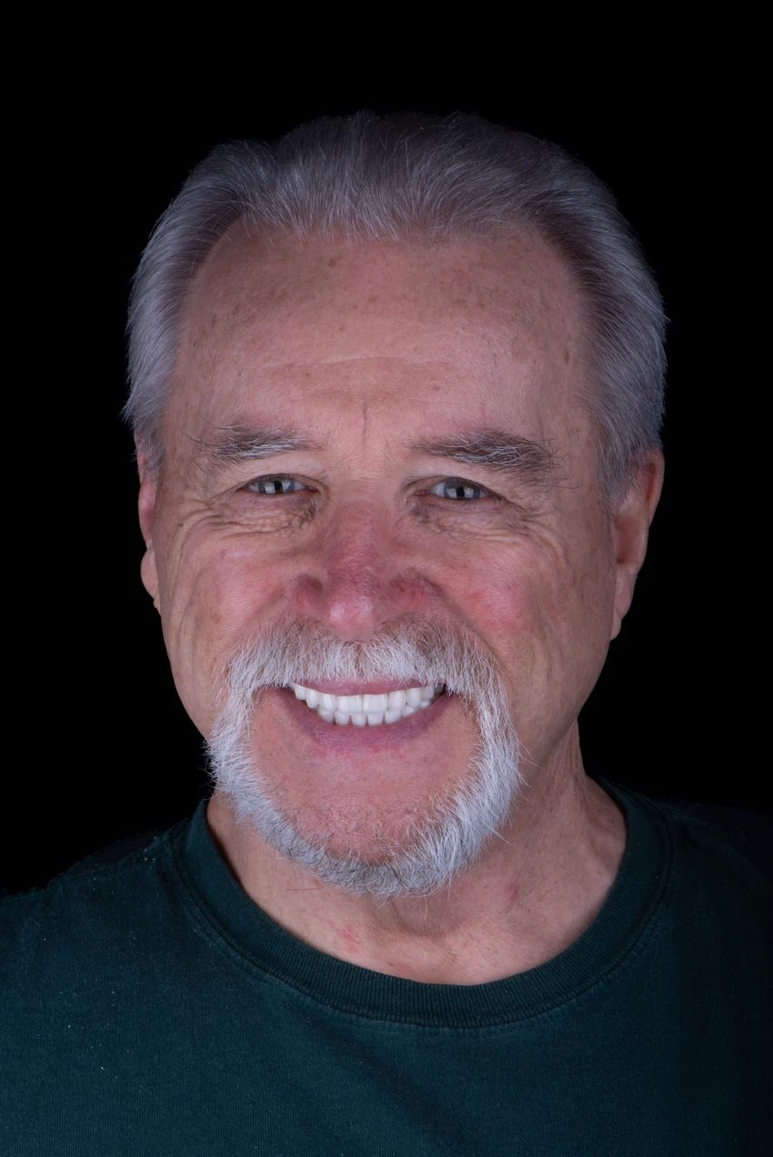 After — Complete smile transformation, portrait