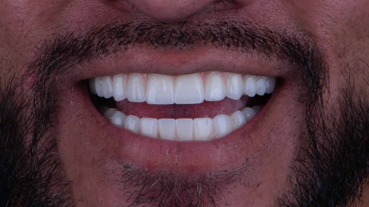 After — Complete smile transformation