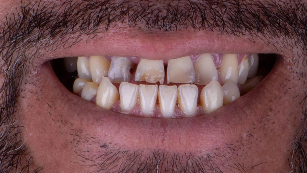 Before — Complete smile transformation