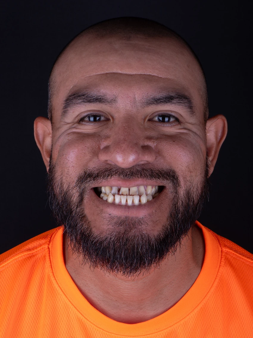 Before — Complete smile transformation, portrait