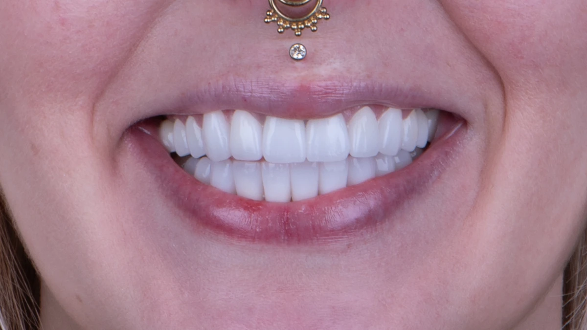 After — Complete smile transformation