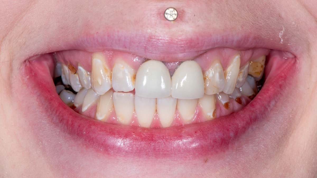 Before — Complete smile transformation
