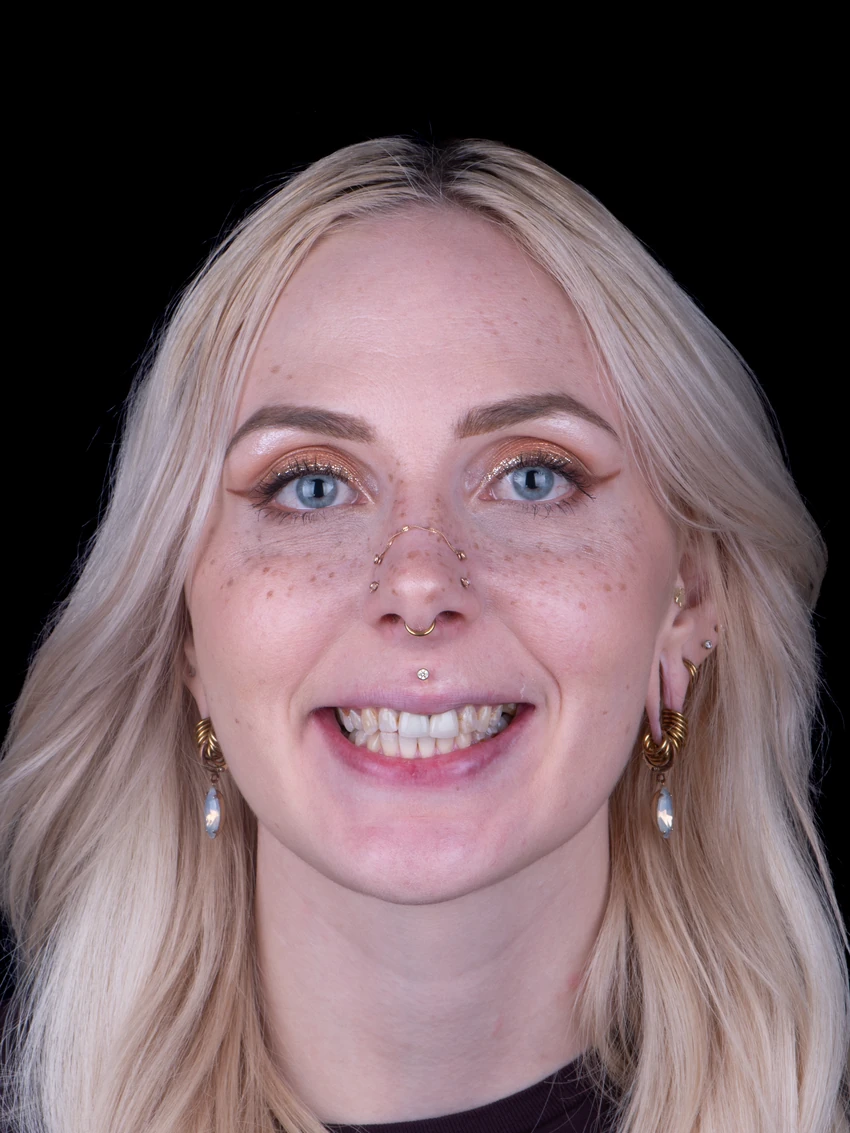 Before — Complete smile transformation, portrait